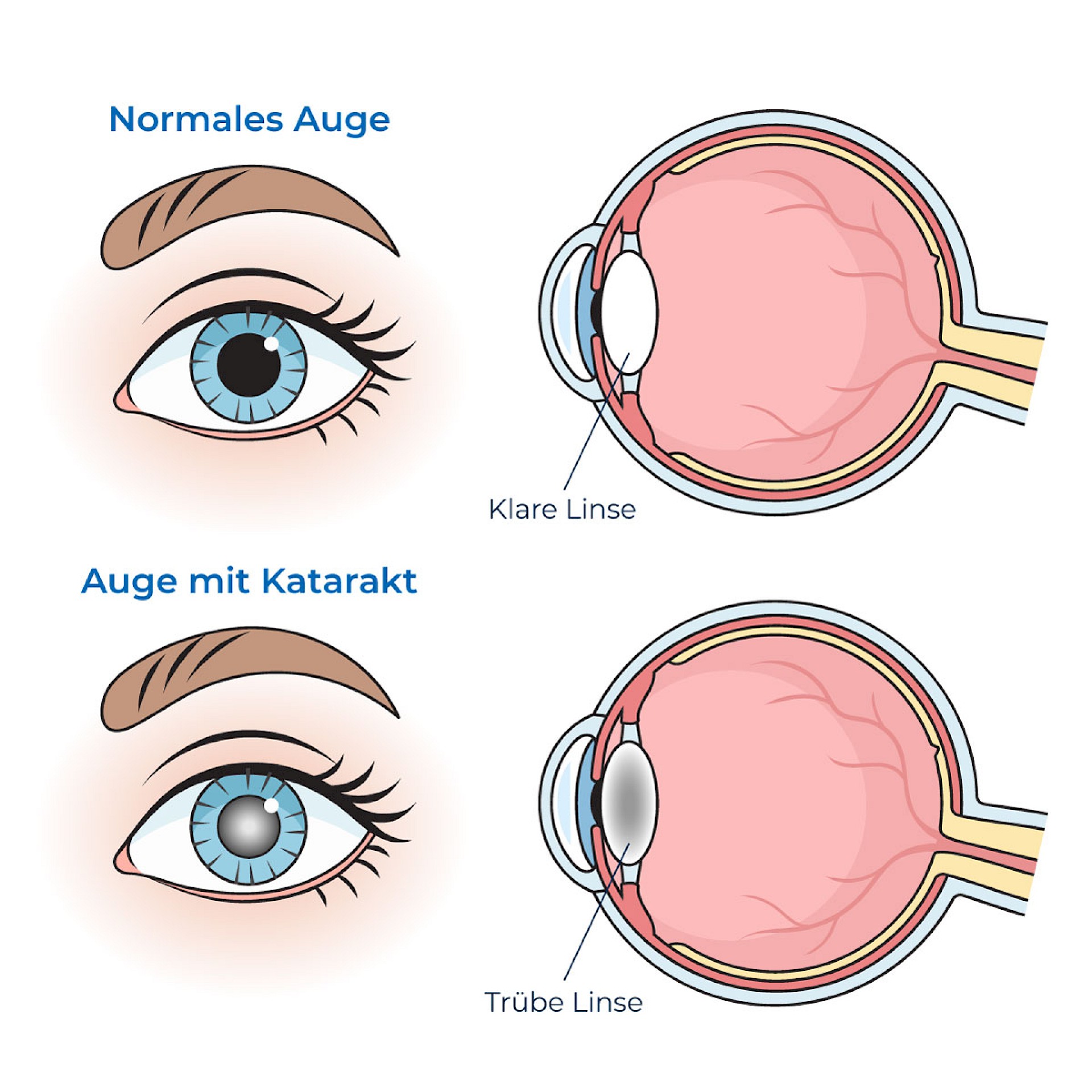 Schematische Darstellung - Oben: Normales Auge mit klarer Linse. Unten: Auge mit Katarakt und trüber Linse.