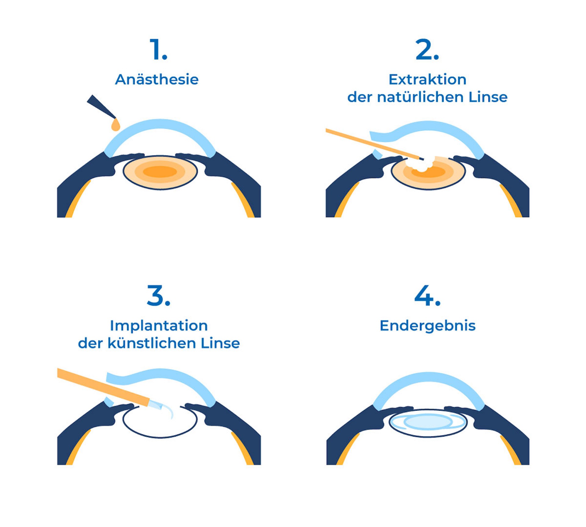 Schematische Darstellung des OP-Verfahrens. 1. Anästhesie, 2. Extraktion der natürlichen Linse, 3. Implantation der künstlichen Linse, 4. Endergebnis