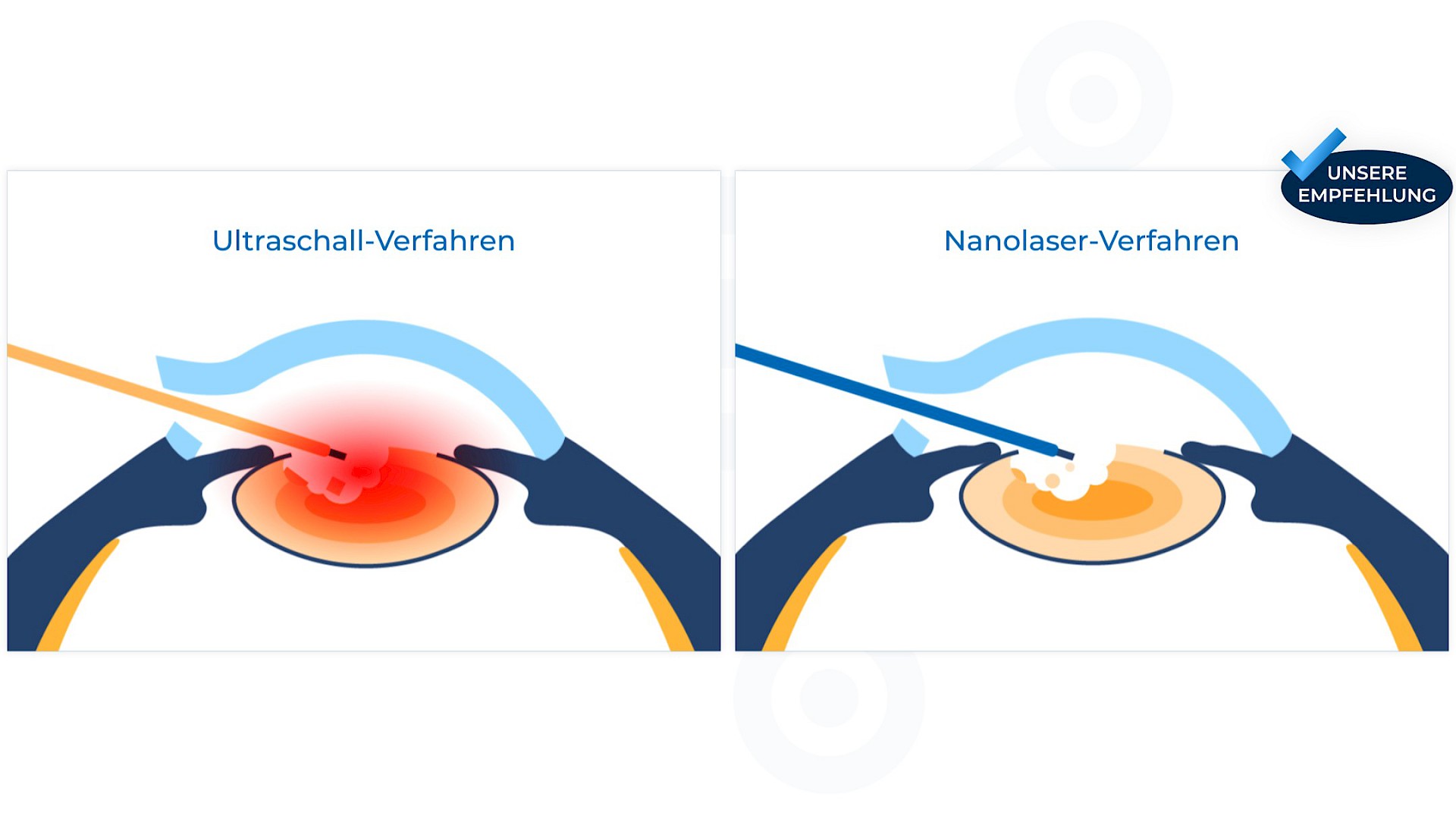 Schematische Darstellung des Ultraschall-Verfahrens (links) und des Nanolaser-Verfahrens (rechts).